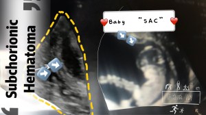 Ultrasound Showing Subchorionic Hematoma during pregnancy